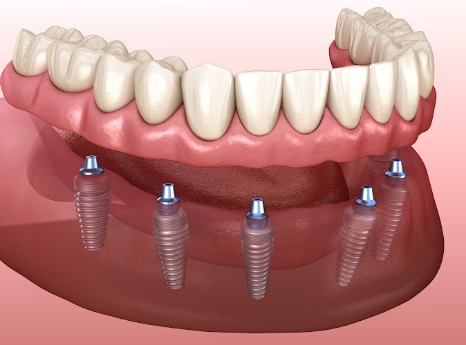 Saltman Implantology & Oral Surgery