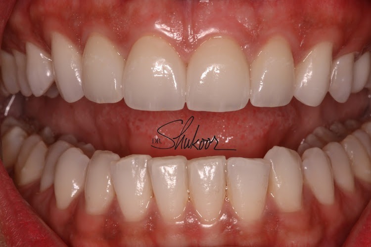 DC Smile and Veneers