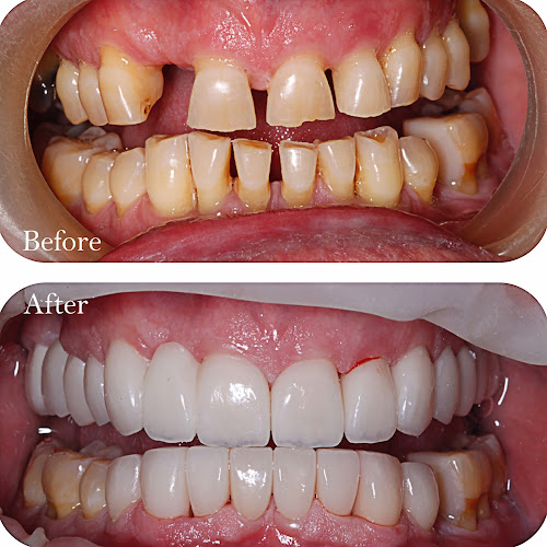 Before and after fixing new teeth for the patient
